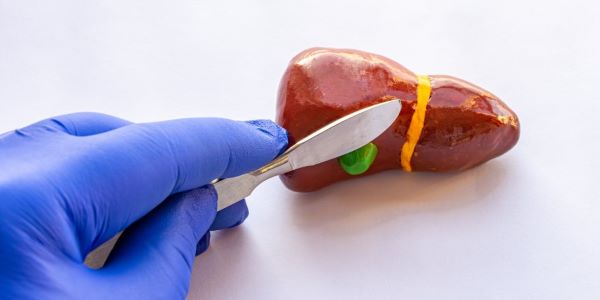 Gallbladder stones treatment - removal