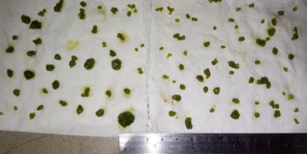 Gallstones flush