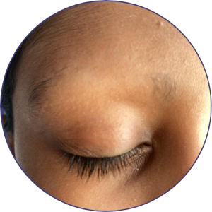 Autoimmune Disease 1